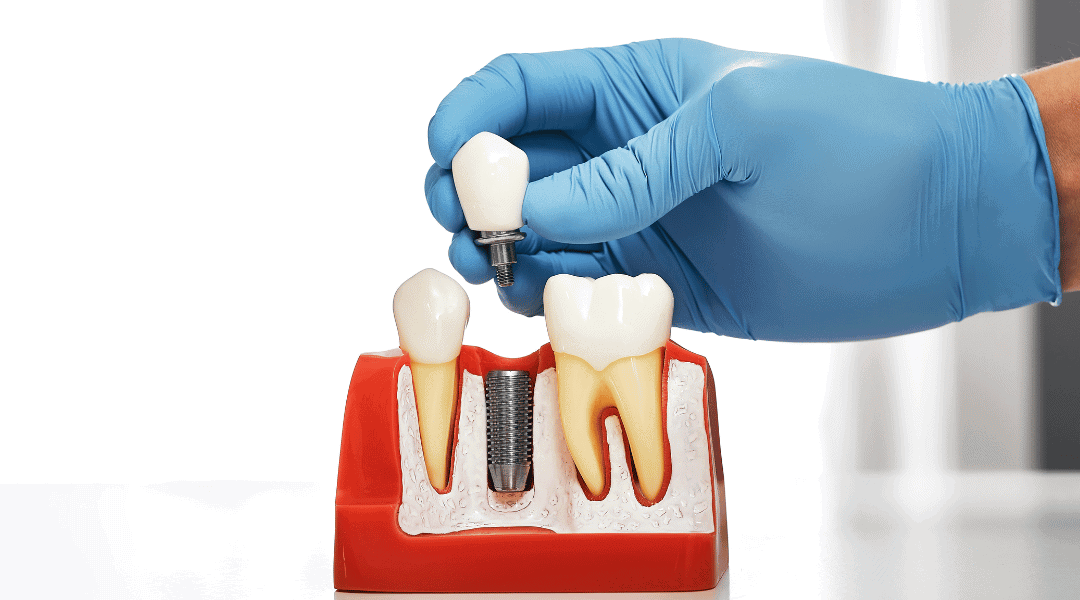 Dental Implants: A Comprehensive Guide in 2024